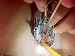 Tenaculum Grasping Cervix For Catheter 7 Min